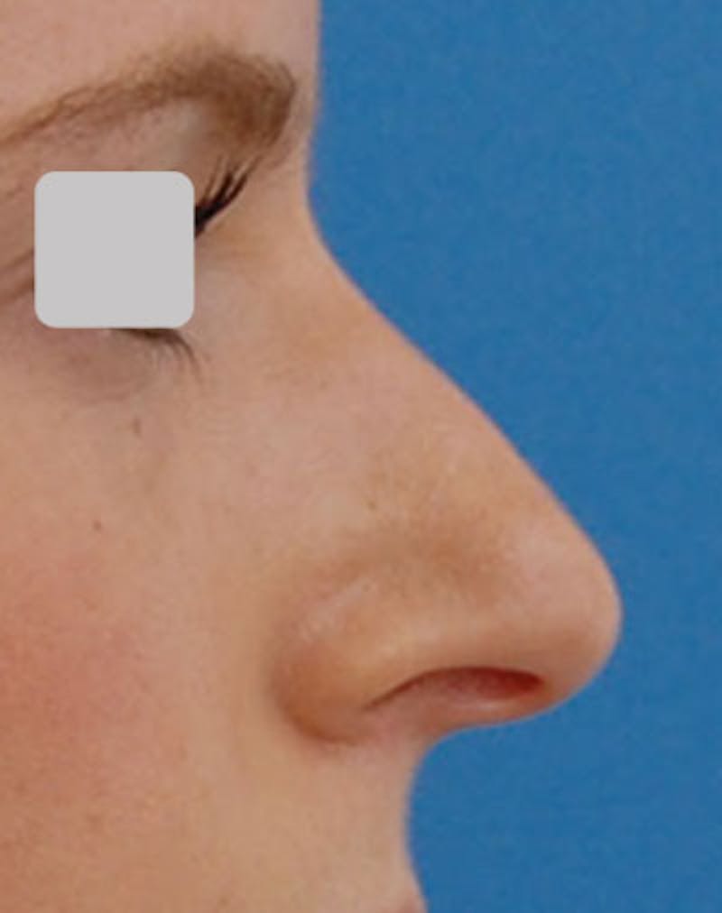 Rhinoplasty Before & After Gallery - Patient 129187 - Image 1