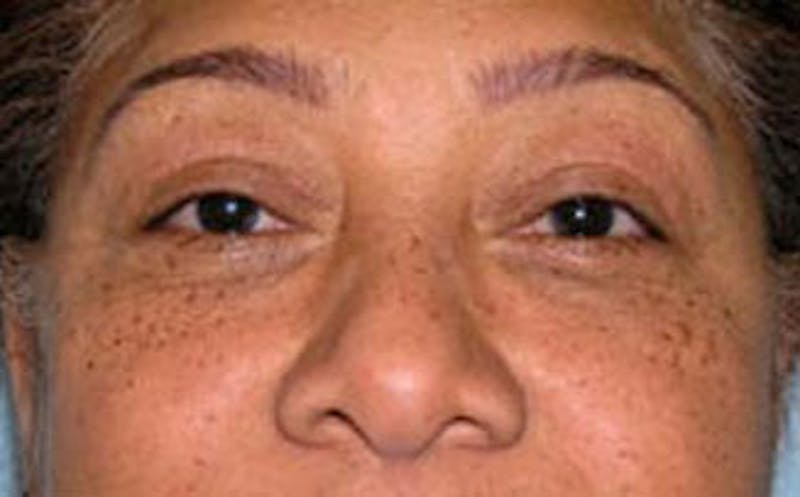 Brow Lift Before & After Gallery - Patient 321376 - Image 2