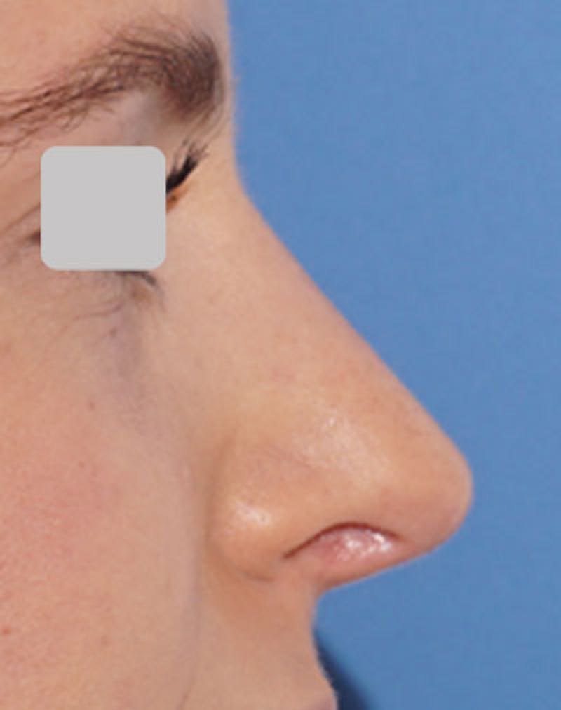 Rhinoplasty Before & After Gallery - Patient 129187 - Image 2