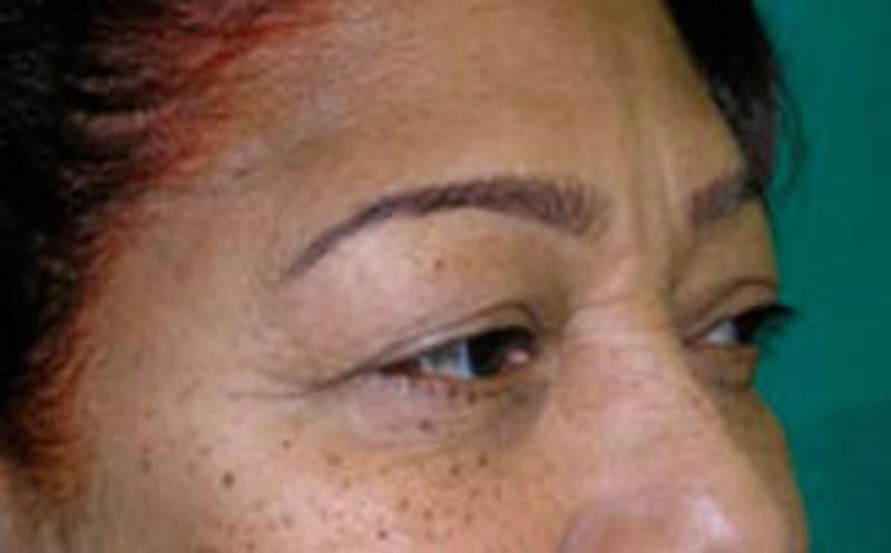 Brow Lift Before & After Gallery - Patient 321376 - Image 3