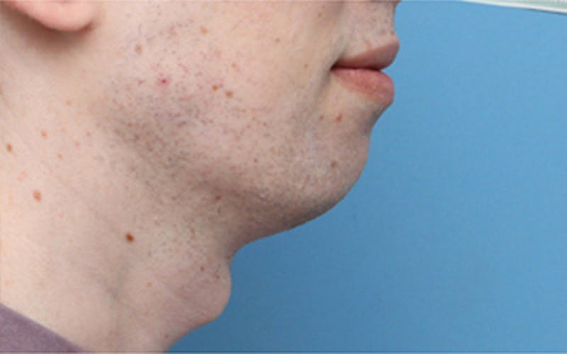 Chin Surgery Before & After Gallery - Patient 343147 - Image 1