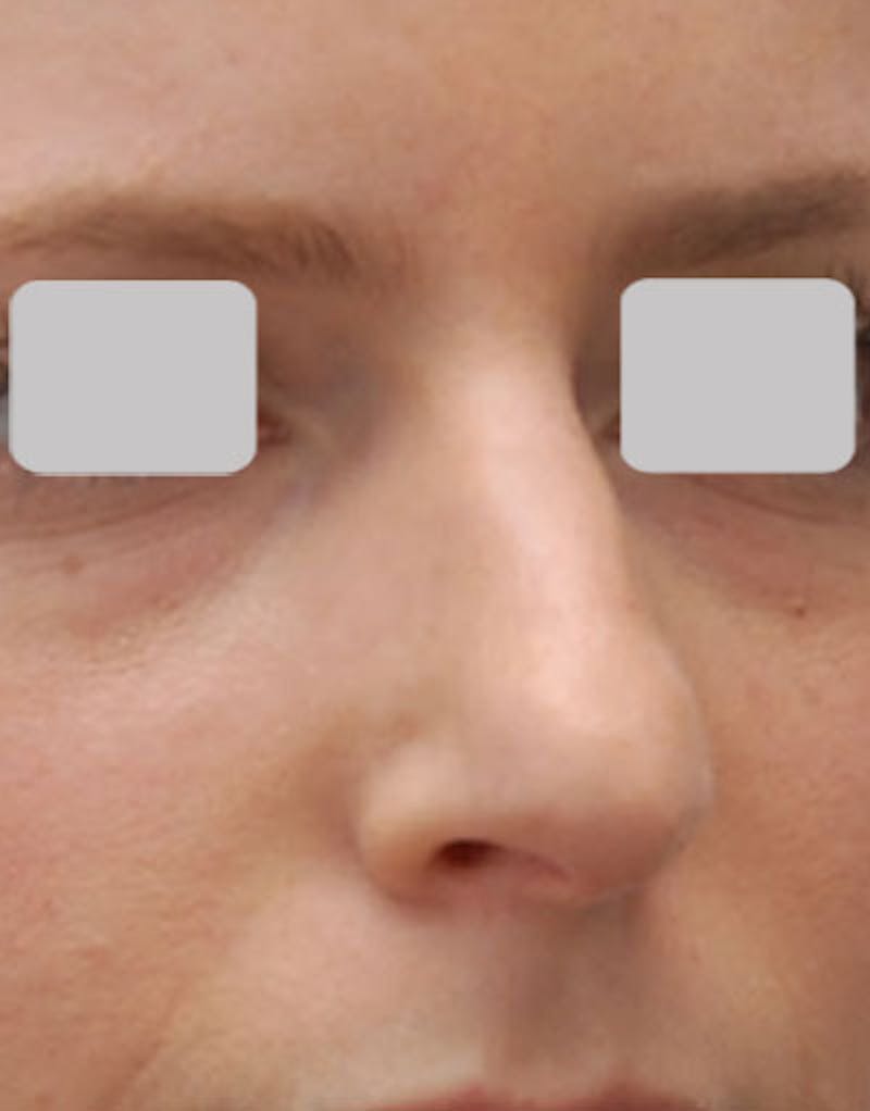Rhinoplasty  Before & After Gallery - Patient 407488 - Image 3