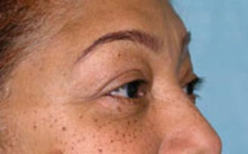 Brow Lift Before & After Gallery - Patient 321376 - Image 4