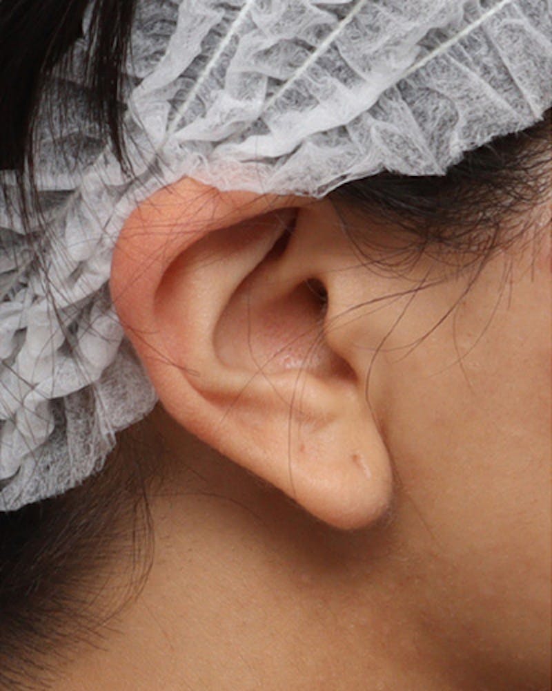 Patient LJXvcmCuSsKARqSr58TGMg - Earlobe Surgery Before & After Photos