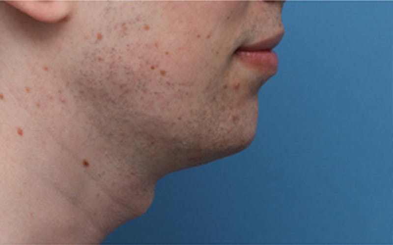 Chin Surgery Before & After Gallery - Patient 343147 - Image 2