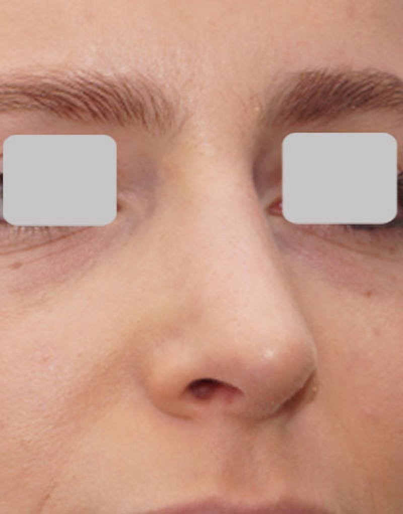Rhinoplasty  Before & After Gallery - Patient 407488 - Image 4