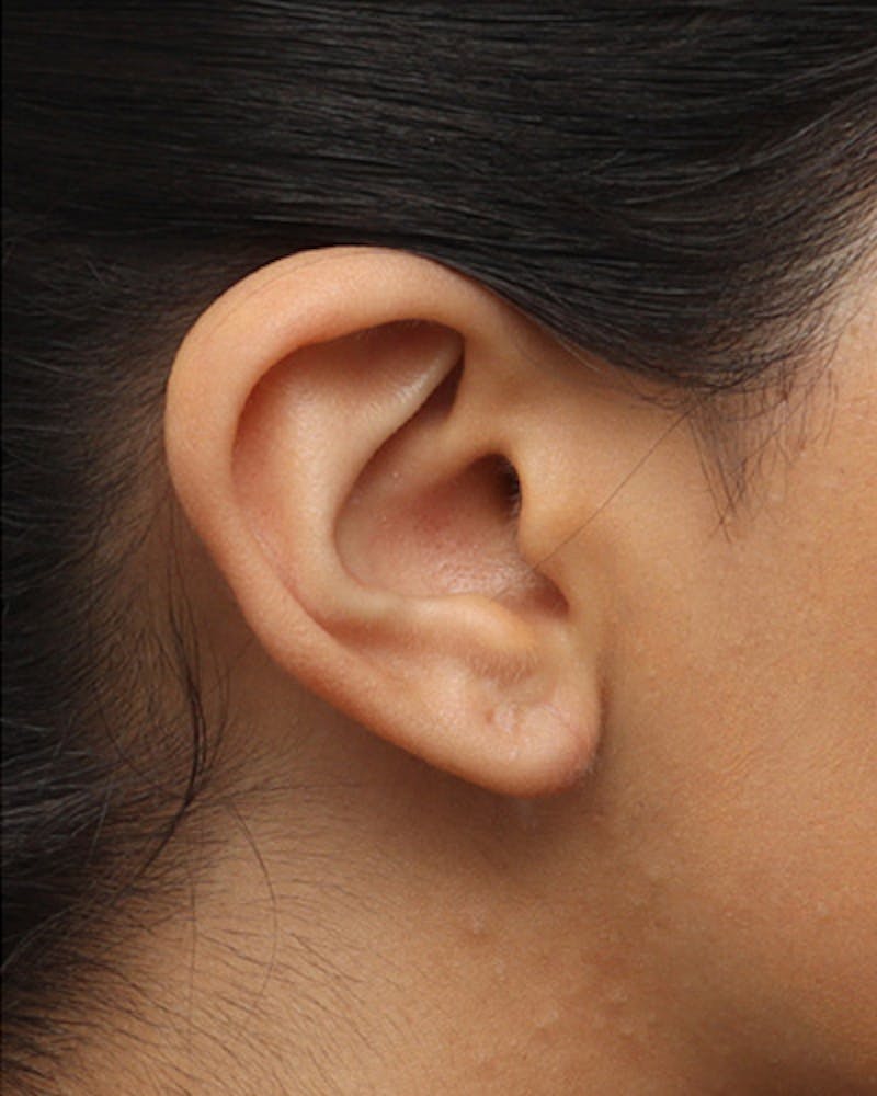 Ear Surgery Before & After Gallery - Patient 354890 - Image 2