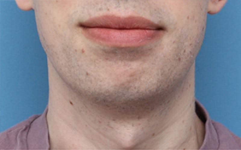 Chin Surgery Before & After Gallery - Patient 343147 - Image 3