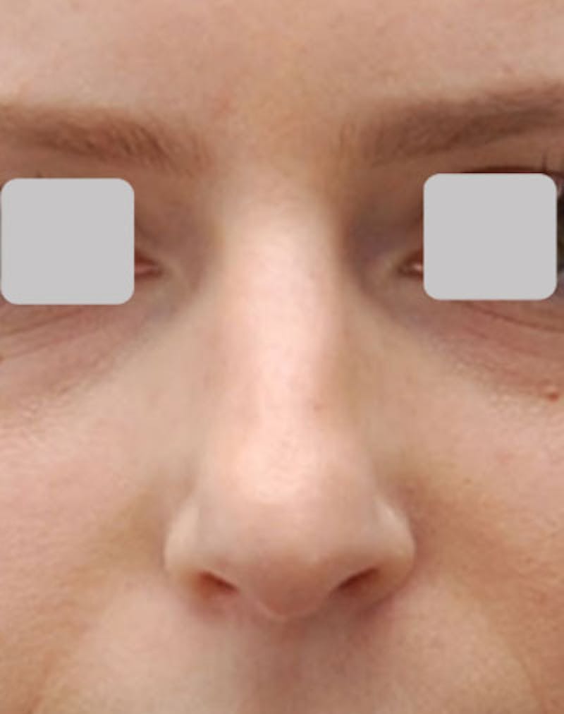 Rhinoplasty  Before & After Gallery - Patient 407488 - Image 5