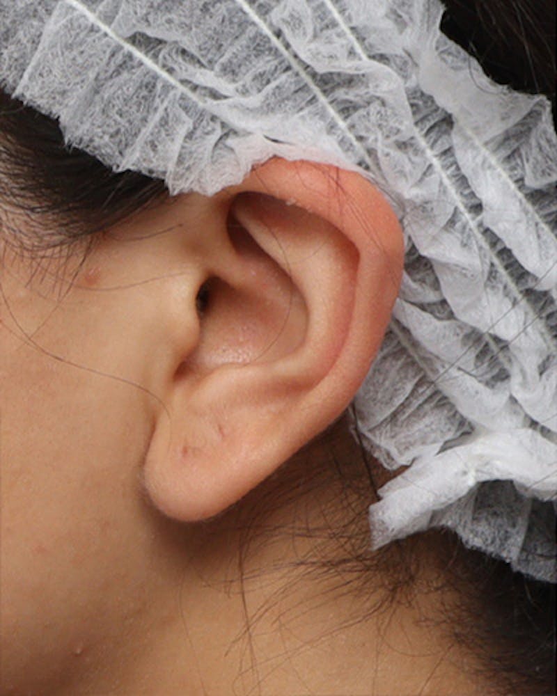 Ear Surgery Before & After Gallery - Patient 354890 - Image 3