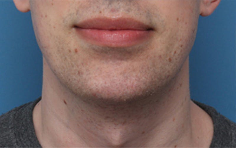 Chin Surgery Before & After Gallery - Patient 343147 - Image 4