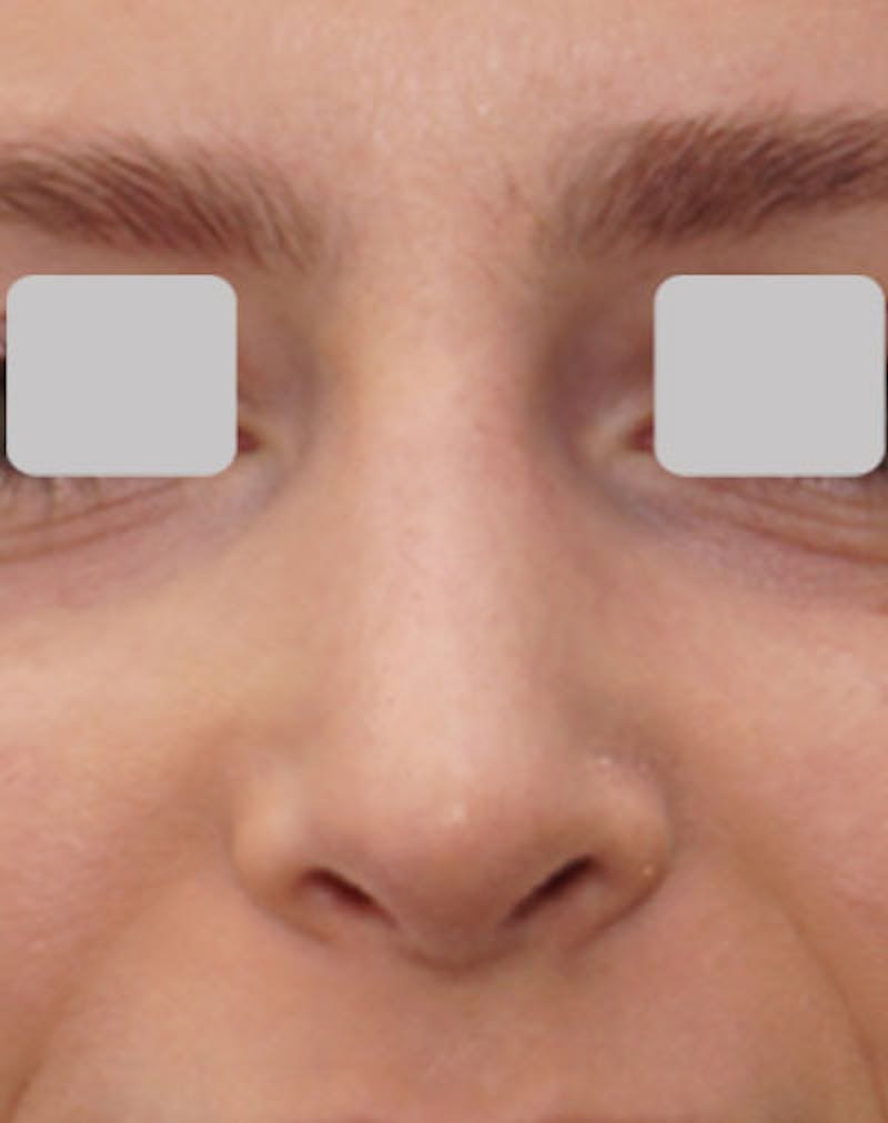 Rhinoplasty  Before & After Gallery - Patient 407488 - Image 6