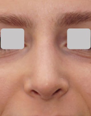 Rhinoplasty Before & After Gallery - Patient 407488 - Image 6