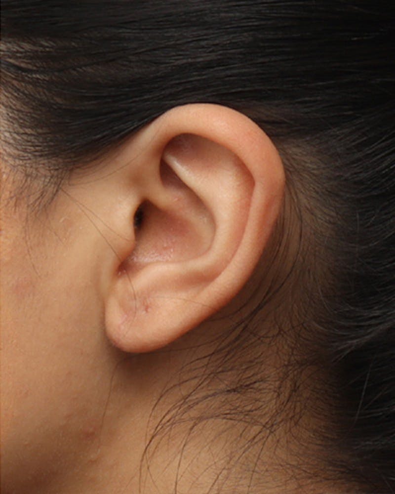Ear Surgery Before & After Gallery - Patient 354890 - Image 4