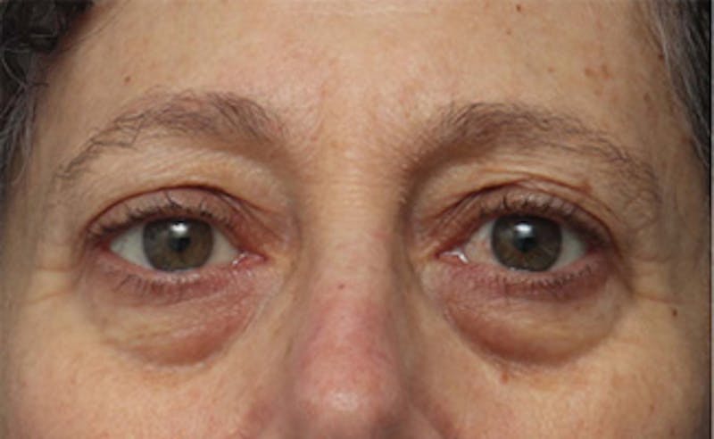 Patient D0g_FgGySjGWeXgyQewFIg - Eyelid Surgery Before & After Photos