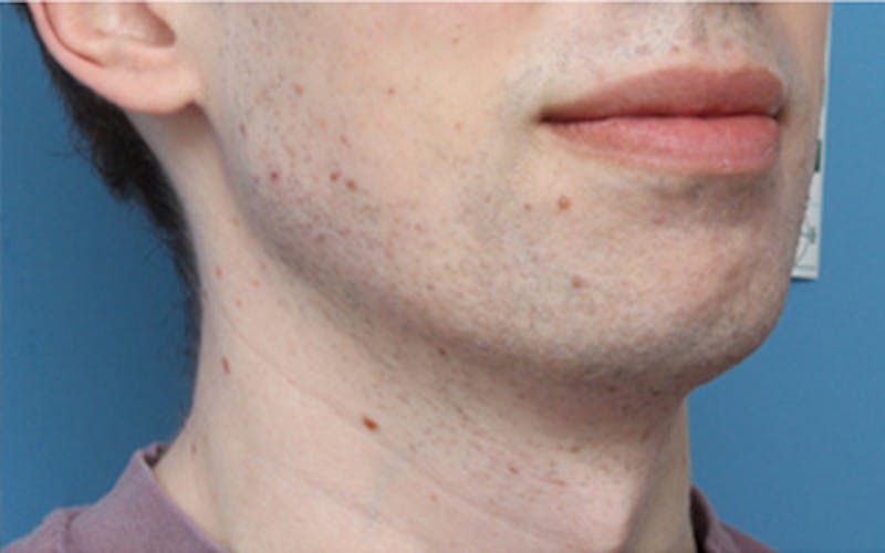Chin Surgery Before & After Gallery - Patient 343147 - Image 5