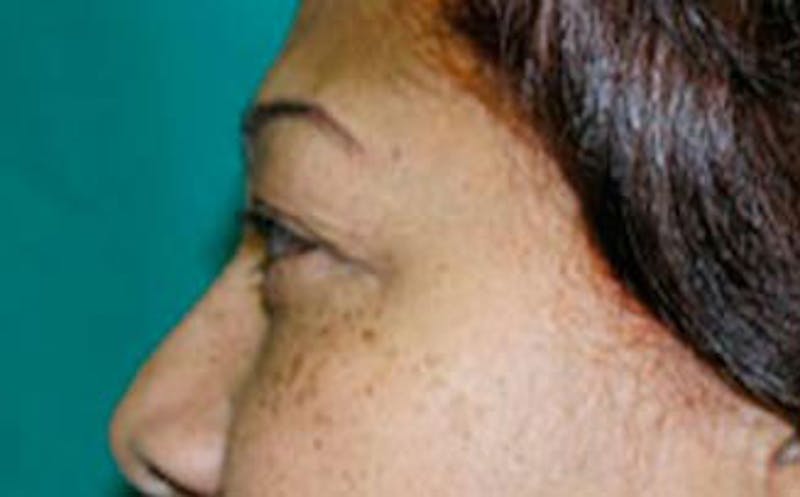 Brow Lift Before & After Gallery - Patient 321376 - Image 5