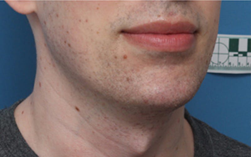 Chin Surgery Before & After Gallery - Patient 343147 - Image 6