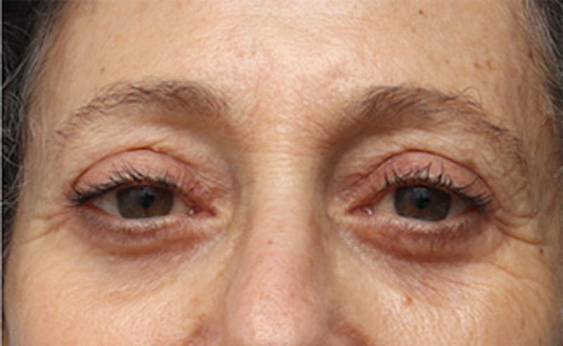 Eyelid Surgery Before & After Gallery - Patient 303461 - Image 2