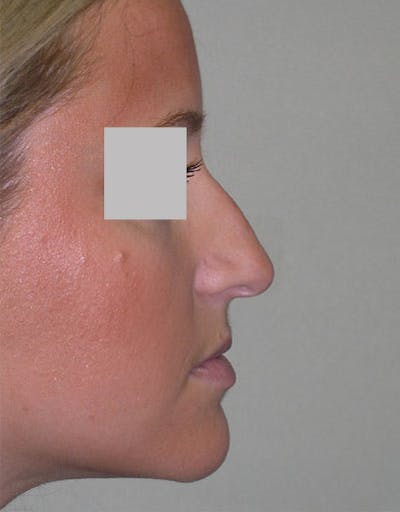 Rhinoplasty Before & After Gallery - Patient 429432 - Image 1