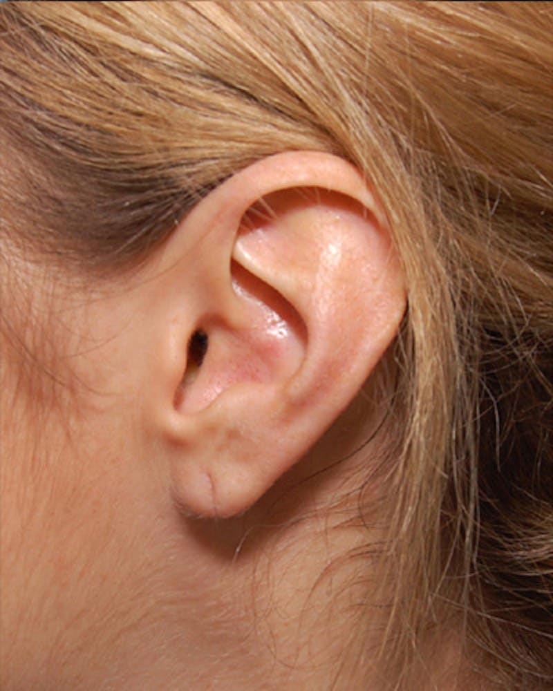 Ear Surgery Before & After Gallery - Patient 383428 - Image 1