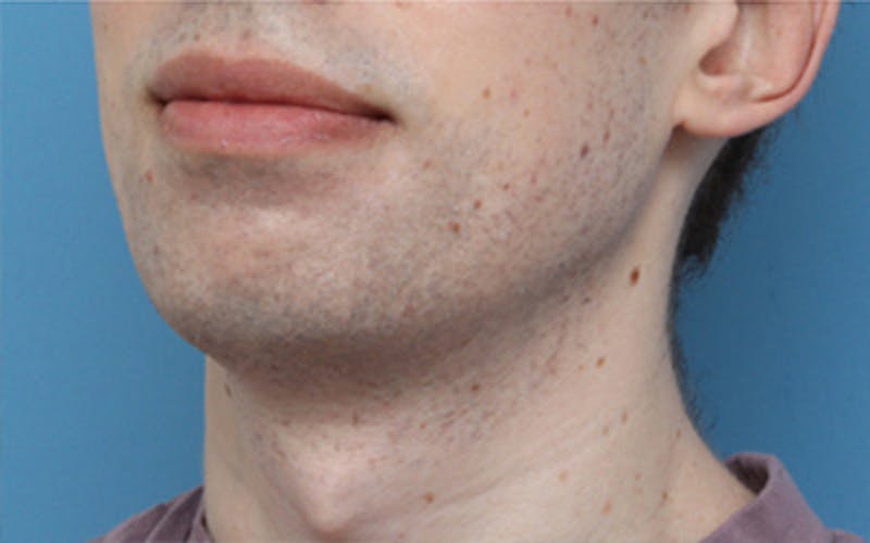Chin Surgery Before & After Gallery - Patient 343147 - Image 7