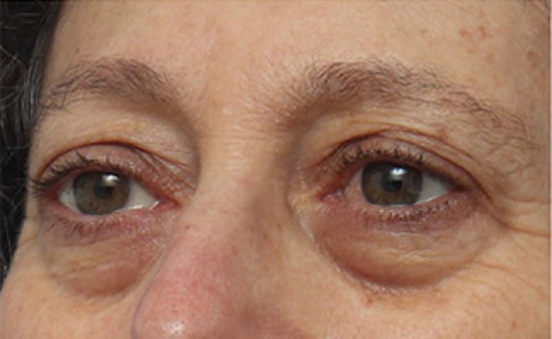 Eyelid Surgery Before & After Gallery - Patient 303461 - Image 3