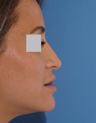 Rhinoplasty Before & After Gallery - Patient 429432 - Image 2