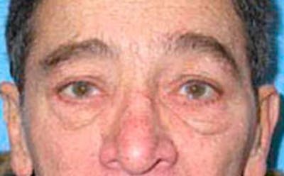 Brow Lift Before & After Gallery - Patient 164087 - Image 1