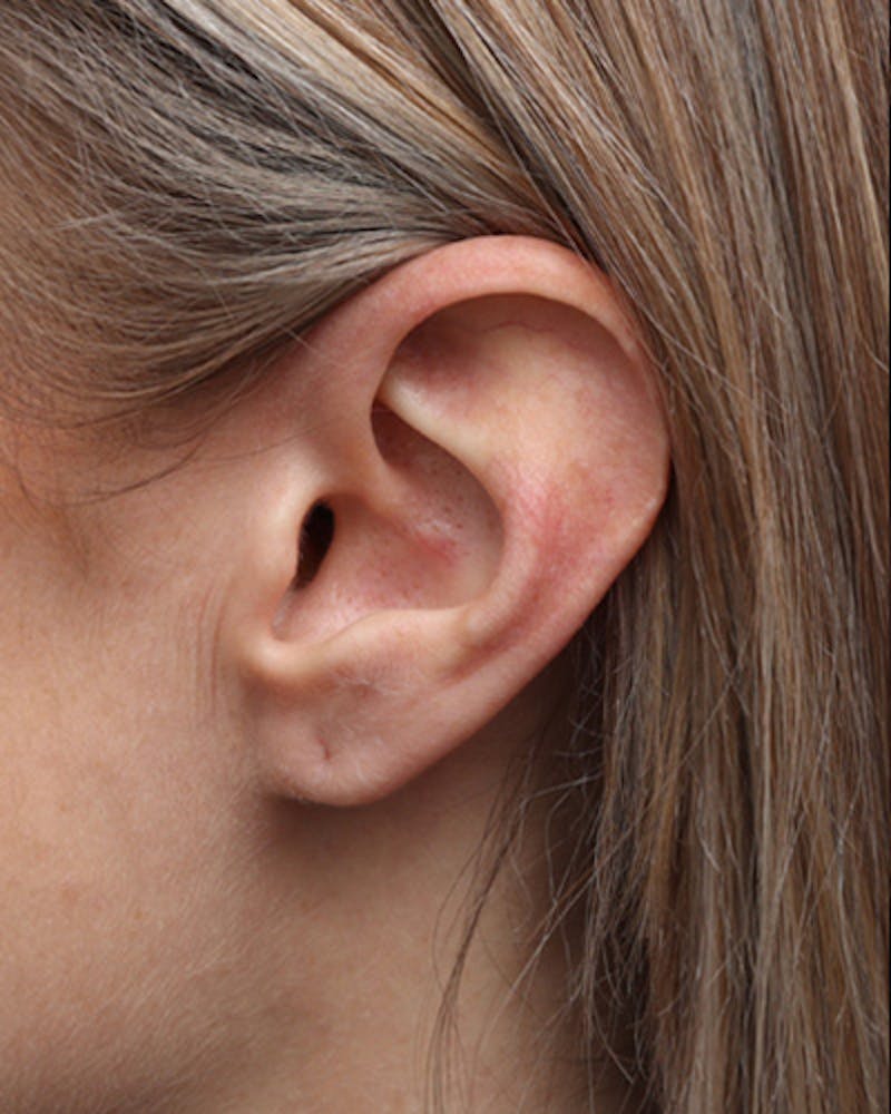 Ear Surgery Before & After Gallery - Patient 383428 - Image 2