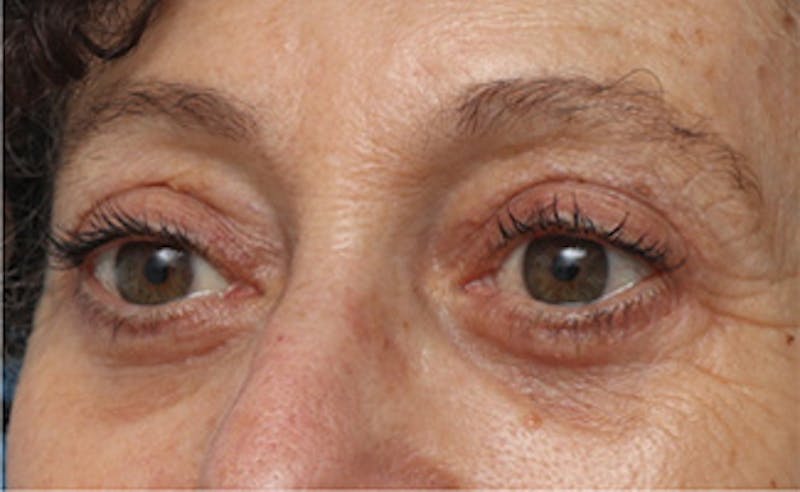 Eyelid Surgery Before & After Gallery - Patient 303461 - Image 4