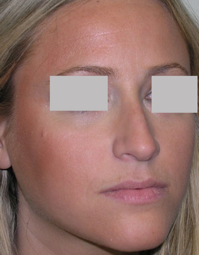 Rhinoplasty Before & After Gallery - Patient 185982 - Image 3