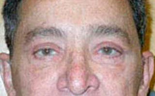 Brow Lift Before & After Gallery - Patient 164087 - Image 2