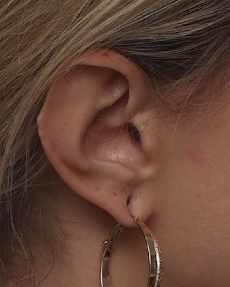 Ear Surgery Before & After Gallery - Patient 139482 - Image 1