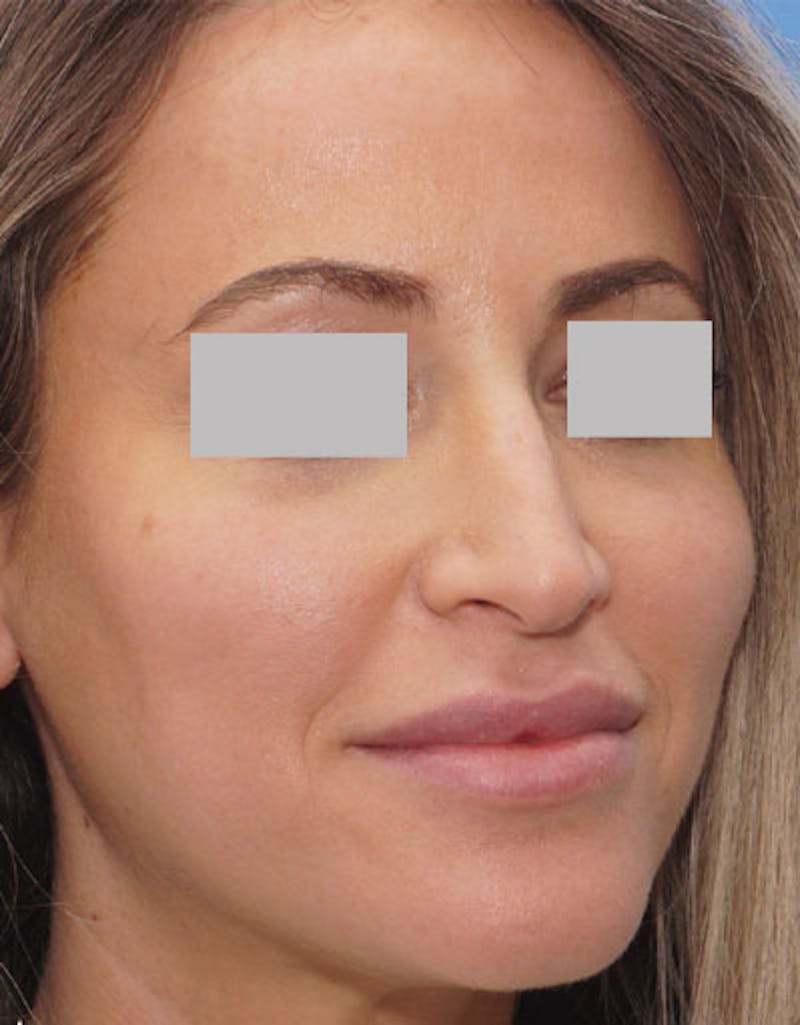 Rhinoplasty Before & After Gallery - Patient 185982 - Image 4