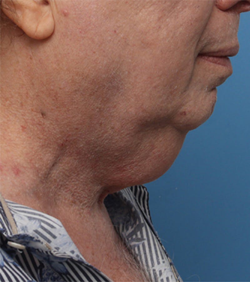 Patient Zc1gIe1SSUS24uZBHX7WPg - Neck Lift Before & After Photos