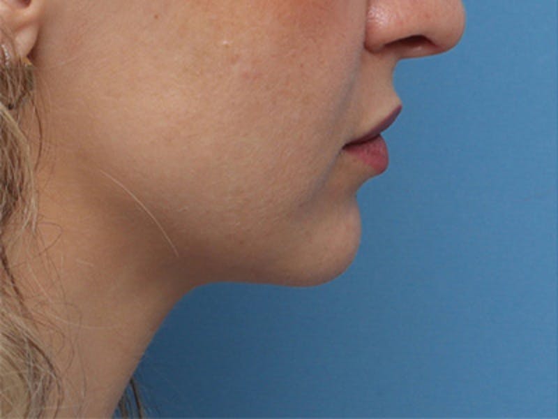 Chin Surgery Before & After Gallery - Patient 144164 - Image 1