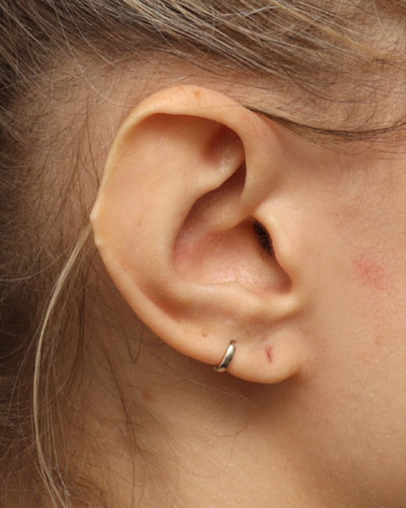 Ear Surgery Before & After Gallery - Patient 139482 - Image 2