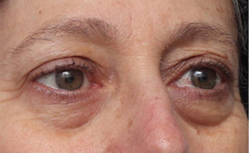 Eyelid Surgery Before & After Gallery - Patient 303461 - Image 5