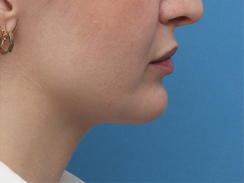Chin Surgery Before & After Gallery - Patient 144164 - Image 2