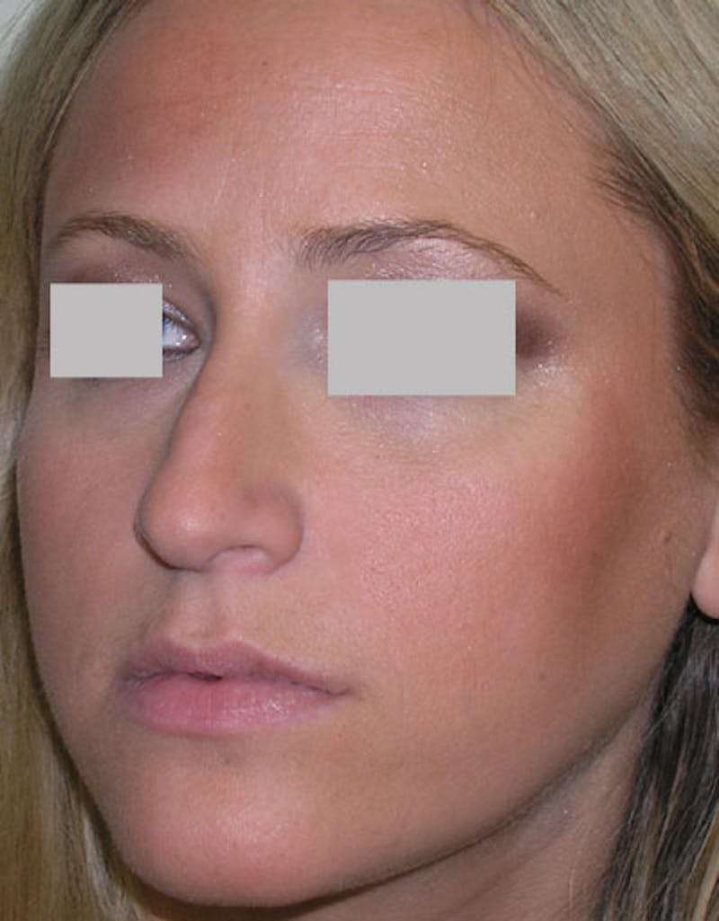 Rhinoplasty Before & After Gallery - Patient 185982 - Image 5
