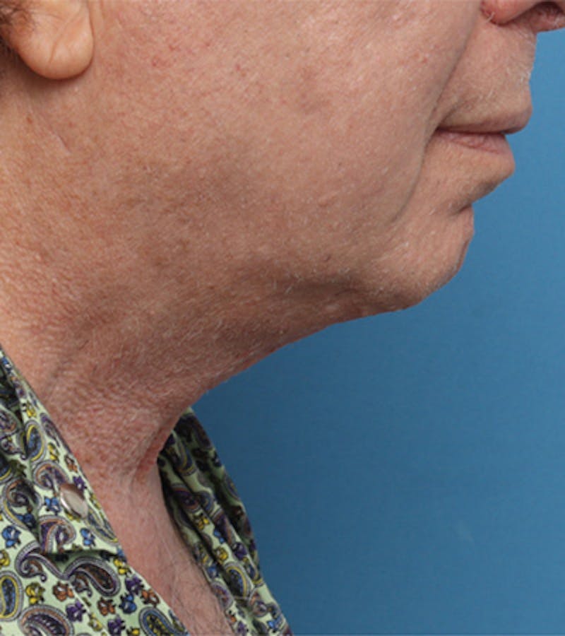 Facelift Before & After Gallery - Patient 324553 - Image 2
