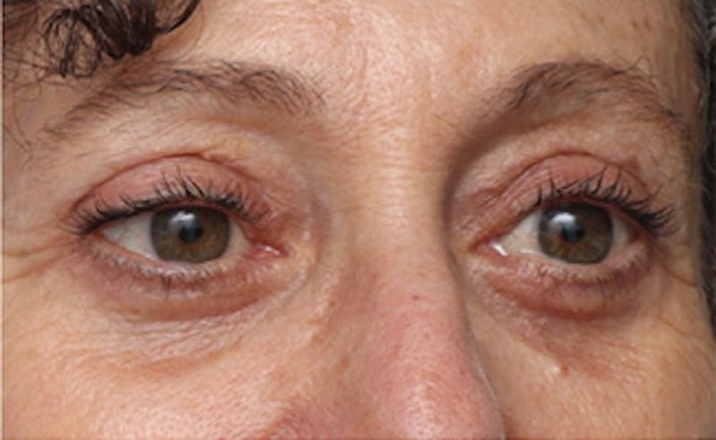Eyelid Surgery Before & After Gallery - Patient 303461 - Image 6