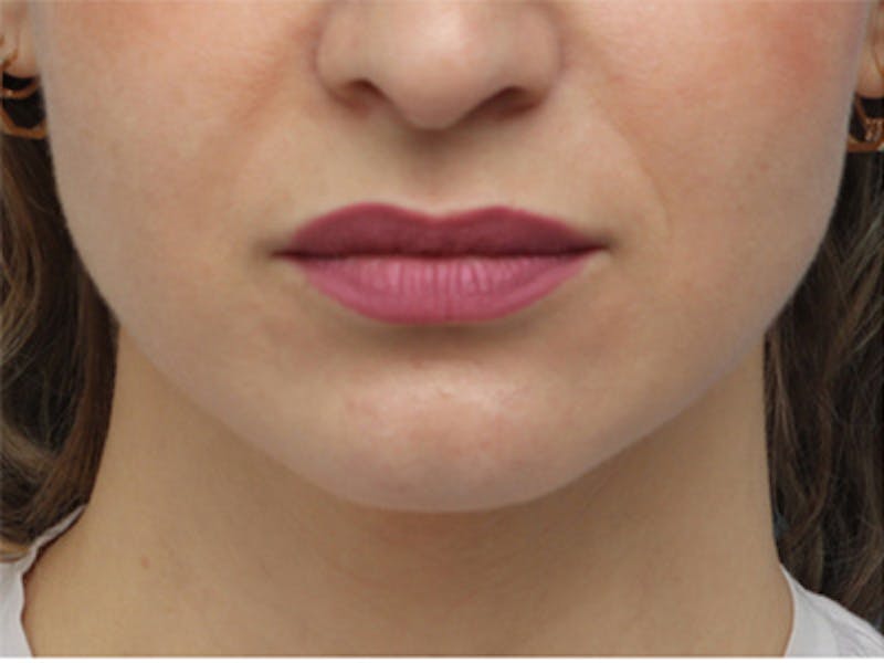 Chin Surgery Before & After Gallery - Patient 144164 - Image 3