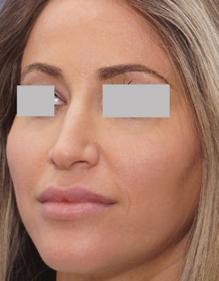 Rhinoplasty Before & After Gallery - Patient 429432 - Image 8