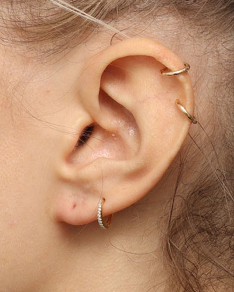 Ear Surgery Before & After Gallery - Patient 139482 - Image 4