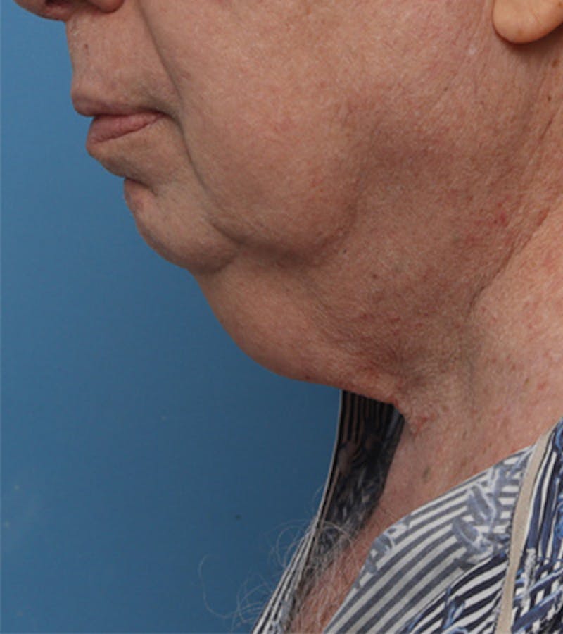 Facelift Before & After Gallery - Patient 324553 - Image 3