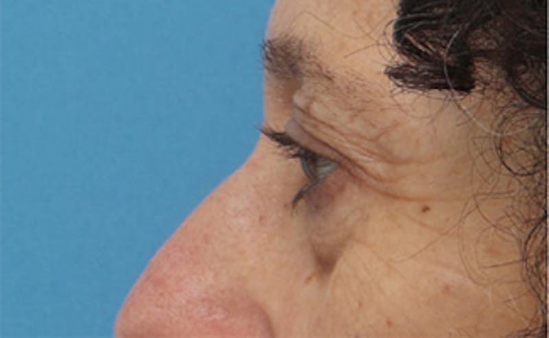 Eyelid Surgery Before & After Gallery - Patient 303461 - Image 7