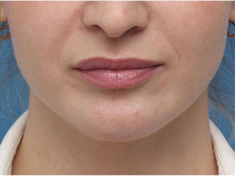 Chin Surgery Before & After Gallery - Patient 144164 - Image 4