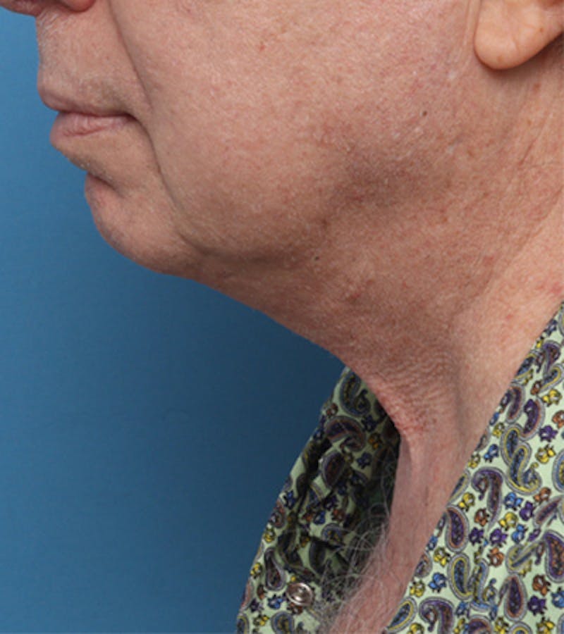 Facelift Before & After Gallery - Patient 324553 - Image 4